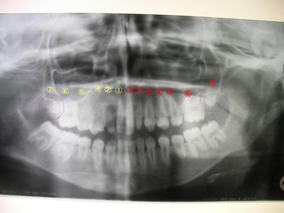x-ray(teeth).JPG